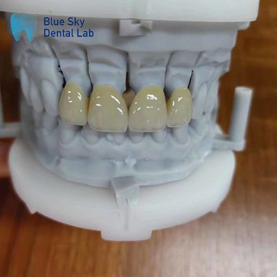acheter Circonia durable recouverte d'une couche de porcelaine couronne de circonie multicouche online manufacture