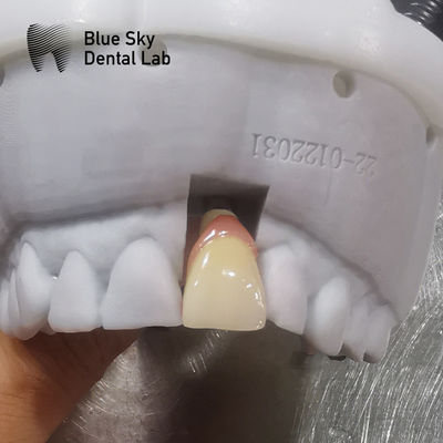acheter Casse d'implant ordinaire Compatibilité universelle Casse d'implant dentaire online manufacture