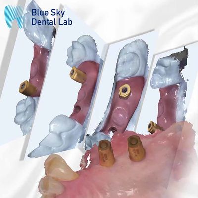 acheter Scan du corps tout en un capsule de guérison dentaire système d'implant Blue Sky online manufacture