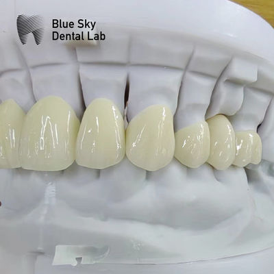acheter Couronne en zirconium à couches translucides Restauration dentaire Couronne en zirconium à couches multiples online manufacture