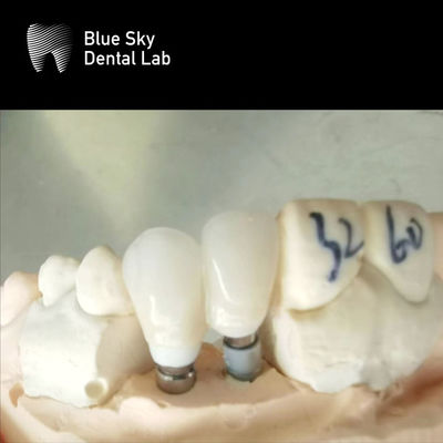 acheter Des couronnes simples, un support en zirconium, des implants dentaires hypoallergéniques, un support en zirconium online manufacture