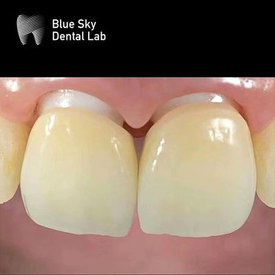 acheter Implantation en zirconium en couches couronne en zirconium abutment biocompatible online manufacture
