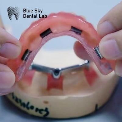 acheter Une dentition dentaire en titane acrylique avec pièces jointes argent et or online manufacture