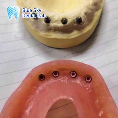 acheter Localisateur de restauration d'implants amovibles Prothèse dentaire de l'implant restauration complète de la bouche online manufacture