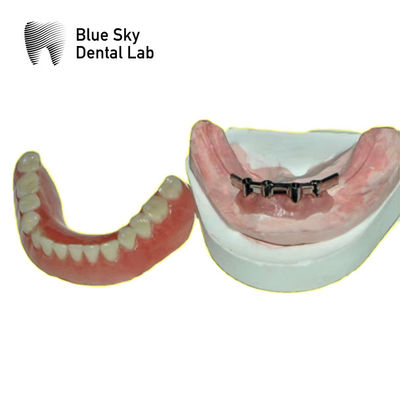 acheter Barre de titane amovible pour dentures bleu ciel online manufacture