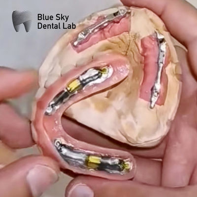 acheter Implants dentaires Blue Sky avec barre de titane pour prothèse amovible online manufacture