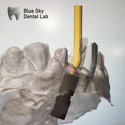 acheter Ti base vis retenue abutment implant angulé abutment du canal de vis online manufacture