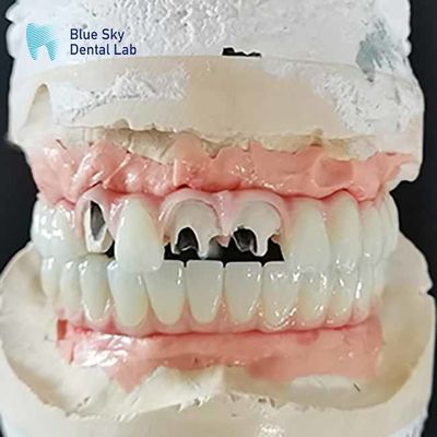 Ponte en titane Malo Ponte implantée sans appuis à plusieurs unités Cimentable