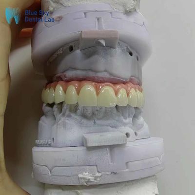 Nature Cases d'implants dentaires artificiels personnalisés Casse d'implants de bouche complète