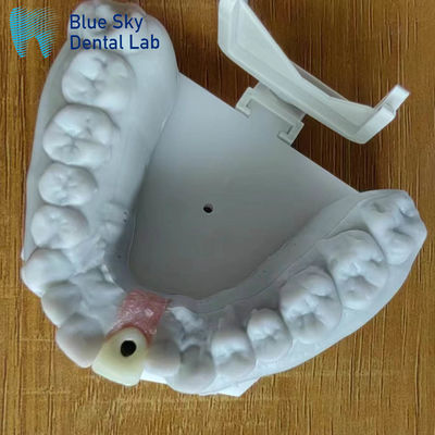 Stérilisation à la vapeur Couronne d'implant simple Couronne d'implant dentaire à surface lisse