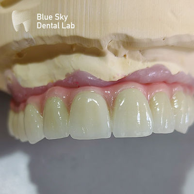 Casque d'implant de bouche complète personnalisé