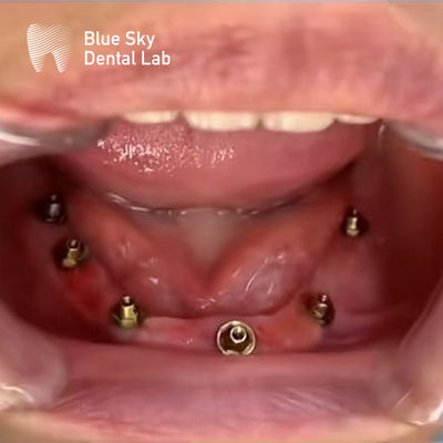 Nature Design Cas d'implant dentaire Cas d'implant d'opération Pour plusieurs choix