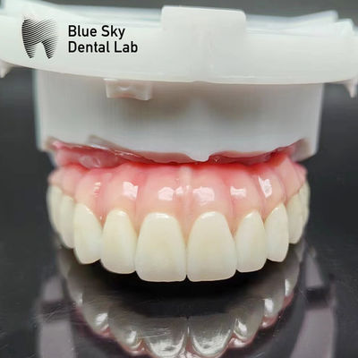 Casque d'implant dentaire naturel pour système d'implant en pleine bouche