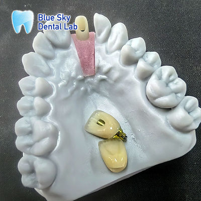 Abutment en zirconium fraisé de précision avec couronne d'implant unique