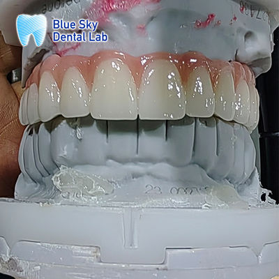 Cas d'implant dentaire artificiel cas d'implant de stérilisation multiple