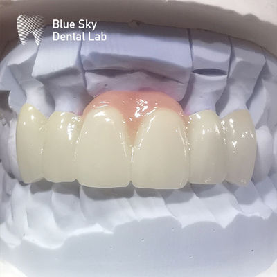 Couronnes en zirconium en couches en porcelaine rose couronne dentaire en zirconium pour les restaurations esthétiques