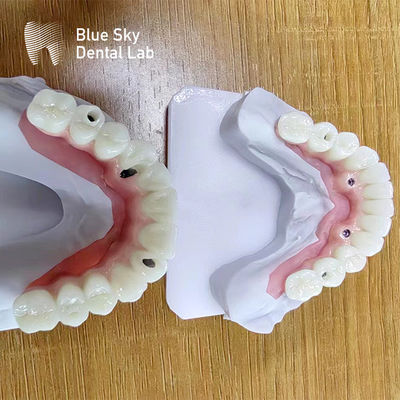 Cas d'implants multifonctionnels personnalisés