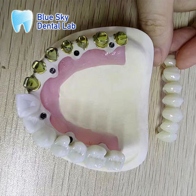Cadre métallique en titane pur d'or d'argent Dental Cadre métallique plaqué d'or partiel