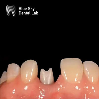 Implant dentaire hypoallergénique
