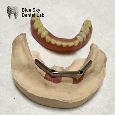 Implantation surdentitaire Barre de titane Implantation dentaire avec prothèse amovible