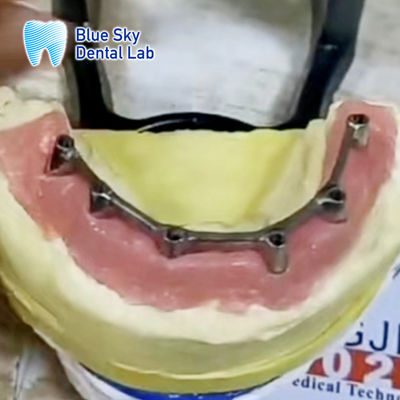Implantation amovible avec surdentité à barres de titane