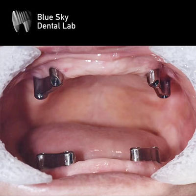 Système d'implants dentaires en titane en résine