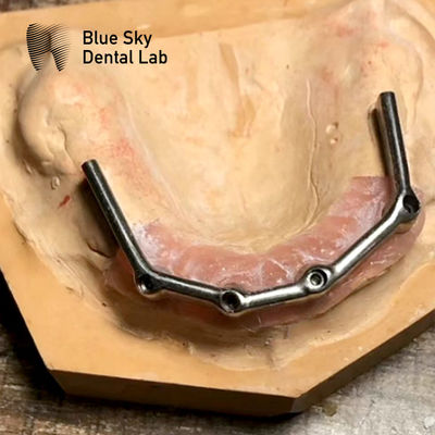 Barre de titane pour la restauration complète de la bouche