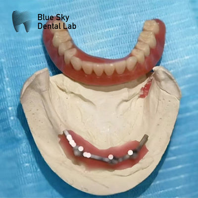Dentiste à barres de titane pour implants dentaires