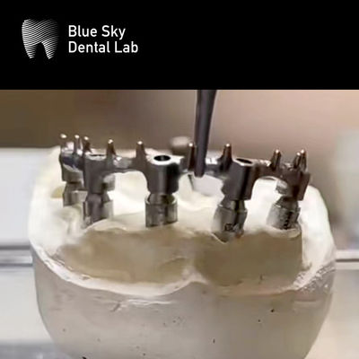 Prothèse amovible Bar dentelle en titane avec ongle