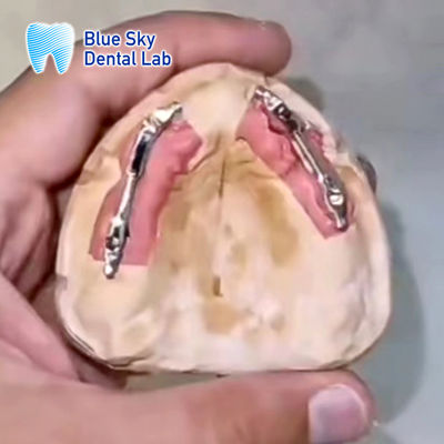 Implants dentaires amovibles en titane à barre segmentée