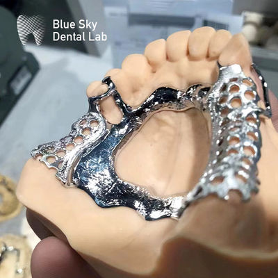 Cadre dentaire bleu ciel Prothèse maxillaire partielle Cadre en métal fondu