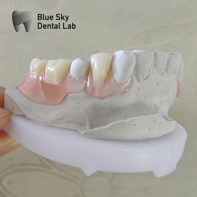 Sourire naturel Prothèses dentaires à plaquette de dentition à plaquette de dentition partielle amovible