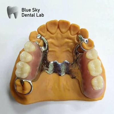 Dentistique en plâtre Prothèse partielle cadre Prothèses partielles qui semblent réelles
