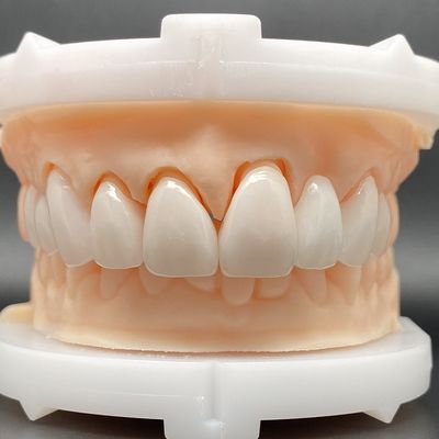 EMax Carcases de placage Passive Adaptation dans plusieurs couleurs Faire un beau sourire avec un minimum de préparation des dents