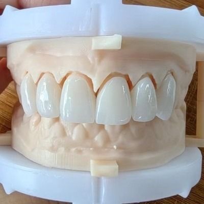 Esthétique naturelle pont de couronne en zirconium en couches pour un beau sourire et une bonne restauration