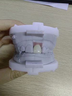 Casque d'implant de haute durabilité pouvant contenir jusqu'à 5 implants pour une flexibilité de prothèse amovible